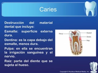 Caries
Destrucción
del
material
dental que incluye:
Esmalte: superficie externa
dura.
Dentina: es la capa debajo del
esmalte, menos dura.
Pulpa: en ella se encuentran
la irrigación sanguínea y el
nervio.
Raíz: parte del diente que se
sujeta al hueso.
Copyright © Nucleus Medical Media, Inc.

 