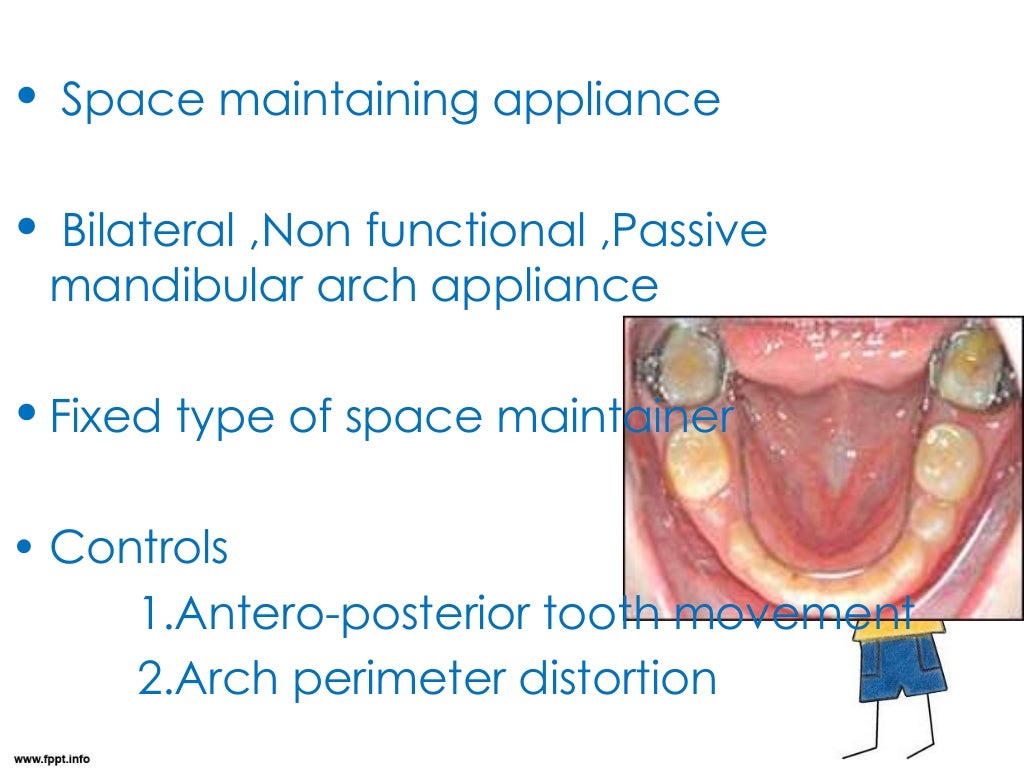 lingual holding arch space maintainer