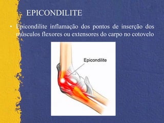 EPICONDILITE
• Epicondilite inflamação dos pontos de inserção dos
músculos flexores ou extensores do carpo no cotovelo
 