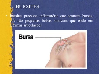 BURSITES
• Bursites processo inflamatório que acomete bursas,
que são pequenas bolsas sinoviais que estão em
algumas articulações
 