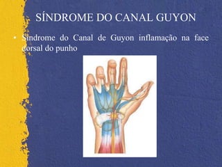 SÍNDROME DO CANAL GUYON
• Síndrome do Canal de Guyon inflamação na face
dorsal do punho
 