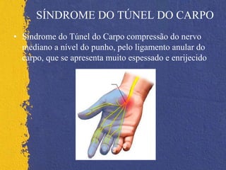 SÍNDROME DO TÚNEL DO CARPO
• Síndrome do Túnel do Carpo compressão do nervo
mediano a nível do punho, pelo ligamento anular do
carpo, que se apresenta muito espessado e enrijecido
 
