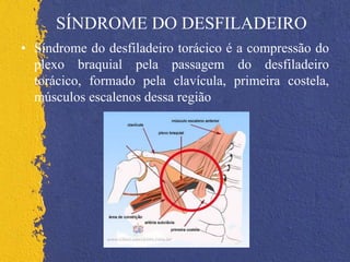 SÍNDROME DO DESFILADEIRO
• Síndrome do desfiladeiro torácico é a compressão do
plexo braquial pela passagem do desfiladeiro
torácico, formado pela clavícula, primeira costela,
músculos escalenos dessa região
 