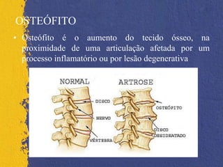 OSTEÓFITO
• Osteófito é o aumento do tecido ósseo, na
proximidade de uma articulação afetada por um
processo inflamatório ou por lesão degenerativa
 