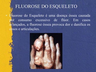 FLUOROSE DO ESQUELETO
• Fluorose do Esqueleto é uma doença óssea causada
por consumo excessivo de flúor. Em casos
avançados, a fluorose óssea provoca dor e danifica os
ossos e articulações.
 