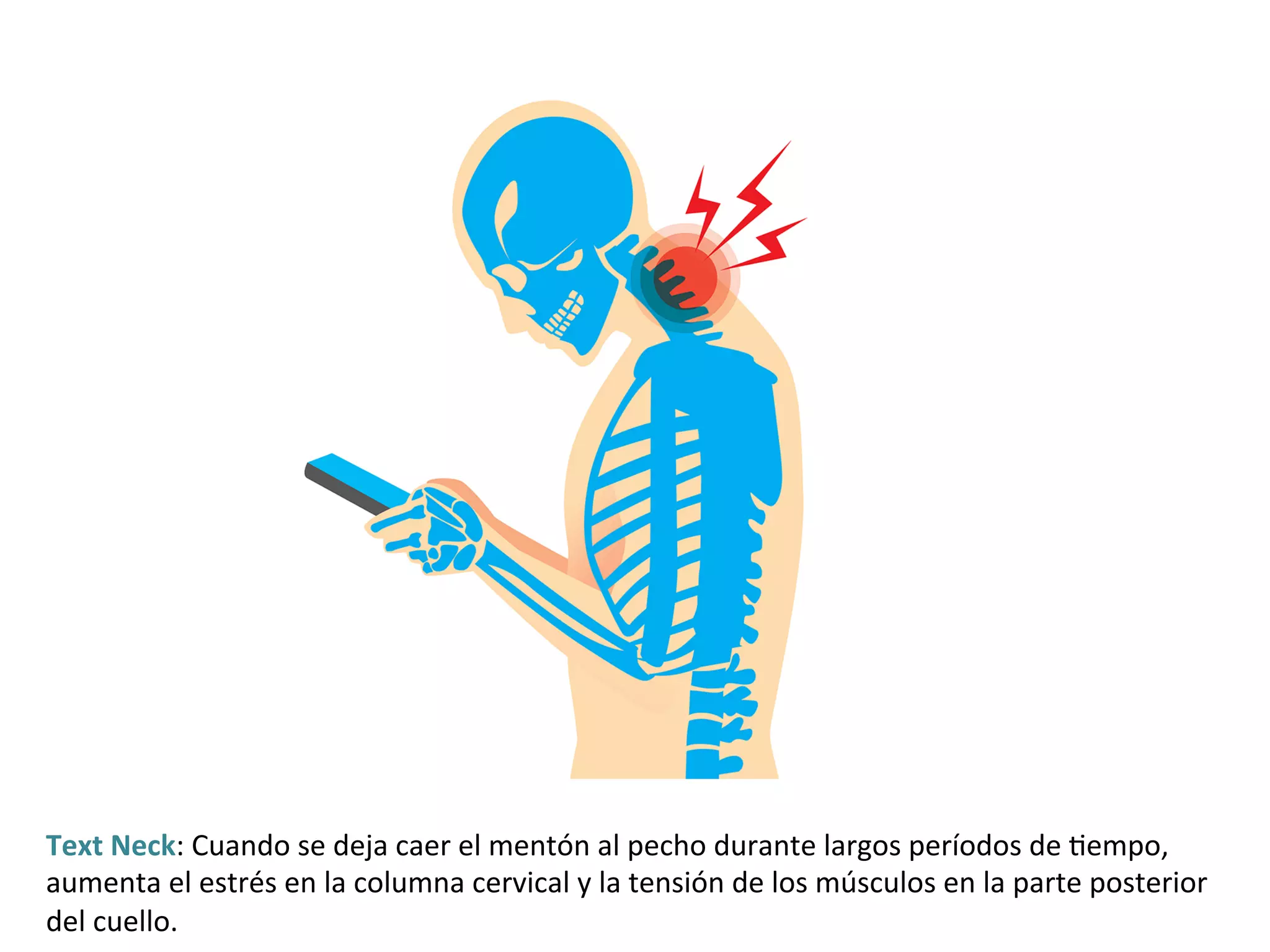 Text	Neck:	Cuando	se	deja	caer	el	mentón	al	pecho	durante	largos	períodos	de	#empo,	
aumenta	el	estrés	en	la	columna	cervical	y	la	tensión	de	los	músculos	en	la	parte	posterior	
del	cuello.		
 