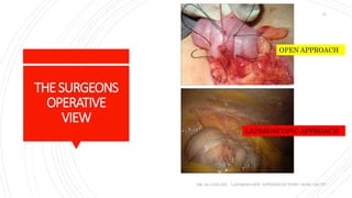THESURGEONS
OPERATIVE
VIEW
DR. AL-GAILANI LAPAROSCOPIC APPENDICECTOMY: HOW I DO IT?
12
OPEN APPROACH
LAPAROSCOPIC APPROACH
 