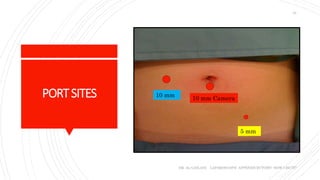 PORTSITES
DR. AL-GAILANI LAPAROSCOPIC APPENDICECTOMY: HOW I DO IT?
24
10 mm
10 mm Camera
5 mm
 