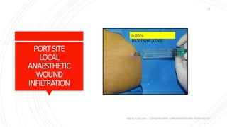 PORTSITE
LOCAL
ANAESTHETIC
WOUND
INFILTRATION
DR. AL-GAILANI LAPAROSCOPIC APPENDICECTOMY: HOW I DO IT?
25
0.25%
BUPIVACAINE
 