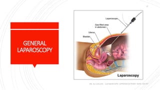 GENERAL
LAPAROSCOPY
DR. AL-GAILANI LAPAROSCOPIC APPENDICECTOMY: HOW I DO IT?
27
 