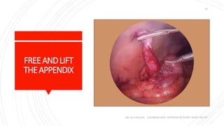 FREEANDLIFT
THEAPPENDIX
DR. AL-GAILANI LAPAROSCOPIC APPENDICECTOMY: HOW I DO IT?
29
 