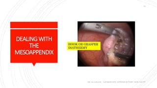 DEALINGWITH
THE
MESOAPPENDIX
DR. AL-GAILANI LAPAROSCOPIC APPENDICECTOMY: HOW I DO IT?
30
HOOK OR GRASPER
DIATHERMY
 