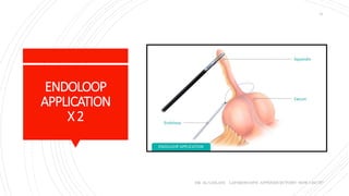 ENDOLOOP
APPLICATION
X2
DR. AL-GAILANI LAPAROSCOPIC APPENDICECTOMY: HOW I DO IT?
31
 