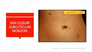 SKINCLOSURE
SUBCUTICULAR
MONOCRIL
DR. AL-GAILANI LAPAROSCOPIC APPENDICECTOMY: HOW I DO IT?
33
AESTHETIC SCARS
 