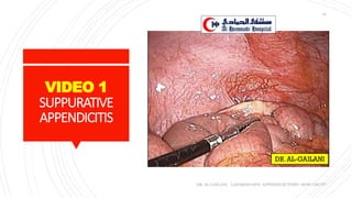 VIDEO 1
SUPPURATIVE
APPENDICITIS
DR. AL-GAILANI LAPAROSCOPIC APPENDICECTOMY: HOW I DO IT?
34
 