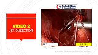VIDEO 2
JET-DISSECTION
DR. AL-GAILANI LAPAROSCOPIC APPENDICECTOMY: HOW I DO IT?
35
DR. AL-
GAILANI
JET
DISSECTION
 