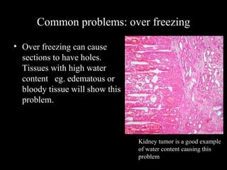 Common problems: over freezing
• Over freezing can cause
sections to have holes.
Tissues with high water
content eg. edematous or
bloody tissue will show this
problem.
Kidney tumor is a good example
of water content causing this
problem
 