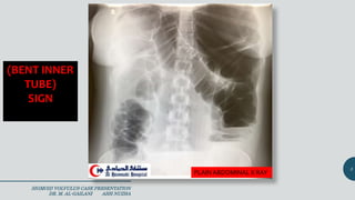 Sigmoid Volvulus Case Presentation 2019 التواء ألقولون | PPTX