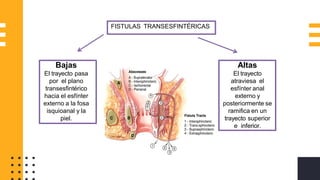 FISTULAS TRANSESFINTÉRICAS
Bajas
El trayecto pasa
por el plano
transesfintérico
hacia el esfínter
externo a la fosa
isquioanal y la
piel.
Altas
El trayecto
atraviesa el
esfínter anal
externo y
posteriormente se
ramifica en un
trayecto superior
e inferior.
 