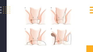 Tipos de Fistulotomia
 