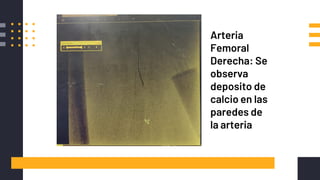 IMÁGENES Y DESCRIPCIÓN Arteria
Femoral
Derecha: Se
observa
deposito de
calcio en las
paredes de
la arteria
 