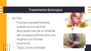 Tratamiento Quirúrgico
▪ SETON
▫ Fistulas transesfintericas
cuando se encuentran
abarcando mas de la mitad de
del complejo esfinteriano y en
mujeres con fistulas
anteriores
▫ Tipos: Corte y drenaje
 