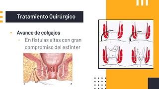 Tratamiento Quirúrgico
▪ Avancede colgajos
▫ En fistulas altas con gran
compromiso del esfinter
 