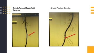 Arteria Femoral Superficial
Derecha
Arteria Poplítea Derecha
 