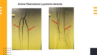 Arteria Tibial anterior y posterior derecha
 