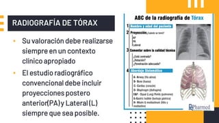 RADIOGRAFÍA DE TÓRAX
▪ Su valoración debe realizarse
siempre en un contexto
clínico apropiado
▪ El estudio radiográfico
convencional debe incluir
proyecciones postero
anterior(PA) y Lateral (L)
siempre que sea posible.
 