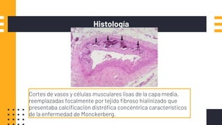 Histología
Cortes de vasos y células musculares lisas de la capa media,
reemplazadas focalmente por tejido fibroso hialinizado que
presentaba calcificación distrófica concéntrica característicos
de la enfermedad de Monckerberg.
 
