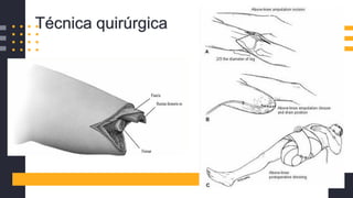 Técnica quirúrgica
 