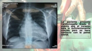 La paciente presenta
Cardiomegalia Grado III
puesto que el corazón
esta lo suficientemente
crecido pero no hace
contacto con la pared
costal.
 