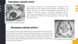 Reemplazo valvular mitral
Esta cirugía consiste en la extracción de la válvula mitral
disfuncional por una nueva ya sea mecánica o biológica. Una
válvula mitral que no cierre completamente permitirá que la
sangre se filtre de nuevo a la aurícula izquierda, esto se
denomina regurgitación mitral. Una válvula mitral que no abre
por completo restringirá el flujo sanguíneo, esto se llama
estenosis mitral.
Reemplazo valvular aórtico
Esta cirugía consiste en la extracción de la válvula aórtica disfuncional.
En pacientes con estenosis aortica calcificada grave, el reemplazo de la
válvula aortica es el único tratamiento eficaz. Además con base en las
características morfológicas y la gravedad de la disfunción valvular, se
puede llevar a cabo el reemplazo de la válvula aórtica para el tratamiento
de la insuficiencia aórtica.
 