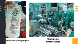 Solución cardioplegica
Circulación
extracórporea
 