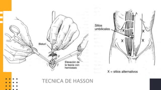 TECNICA DE
HASSON
LAPAROSCOPICA
 