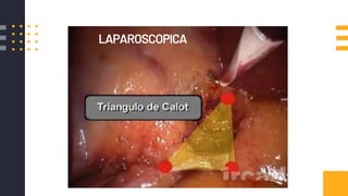 LAPAROSCOPICA
 