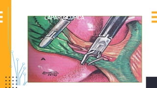 LAPAROSCOPICA
 