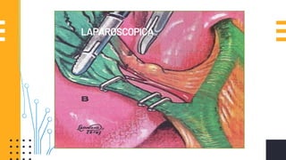 LAPAROSCOPICA
 