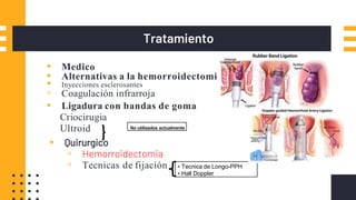 Tratamiento
▪ Medico
▪ Alternativas a la hemorroidectomia
▪ Inyecciones esclerosantes
▫ Coagulación infrarroja
▪ Ligadura con bandas de goma
Criocirugia
Ultroid
▪ Quirurgico
▫ Hemorroidectomia
▫ Tecnicas de fijación
No utilizados actualmente
• Tecnica de Longo-PPH
• Hall Doppler
 
