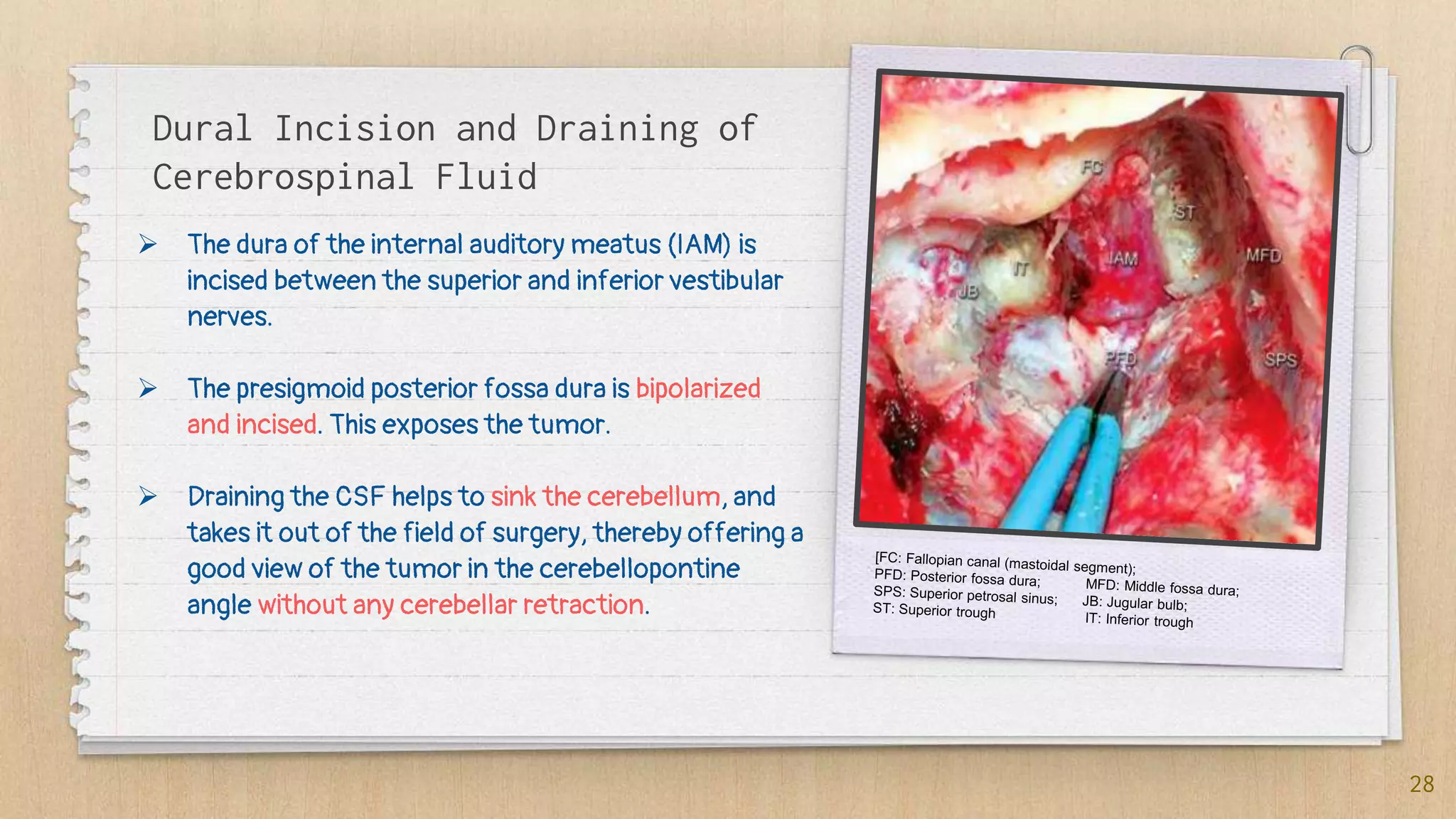 Vestibular schwannoma (acoustic neuroma) surgical anatomy and ...