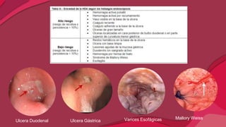 Ulcera Gástrica
Ulcera Duodenal Varices Esofágicas Mallory Weiss
 