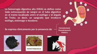 Hematemesis
Hematoquecia
Melena
La hemorragia digestiva alta (HDA) se define como
toda extravasación de sangre en el tubo digestivo
en el tramo localizado entre el esófago y el ángulo
de Treitz, es decir, un sangrado que involucre
esófago, estómago o duodeno.
Se expresa clínicamente por la presencia de:
 