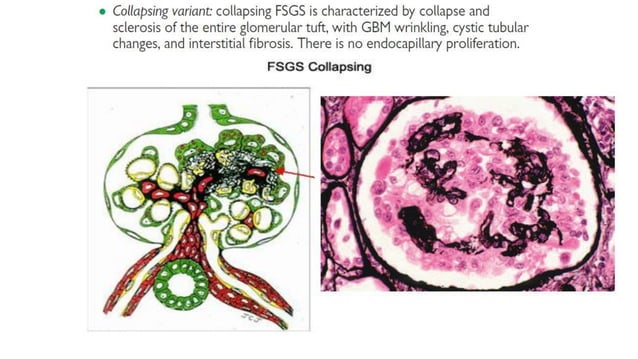 Focal Segmental Glomerulosclerosis - FSGS (KDIGO 2021 Guidelines) - Dr ...
