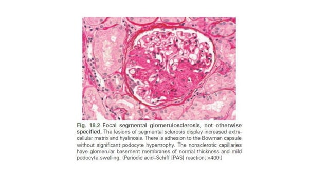 Focal Segmental Glomerulosclerosis - FSGS (KDIGO 2021 Guidelines) - Dr ...