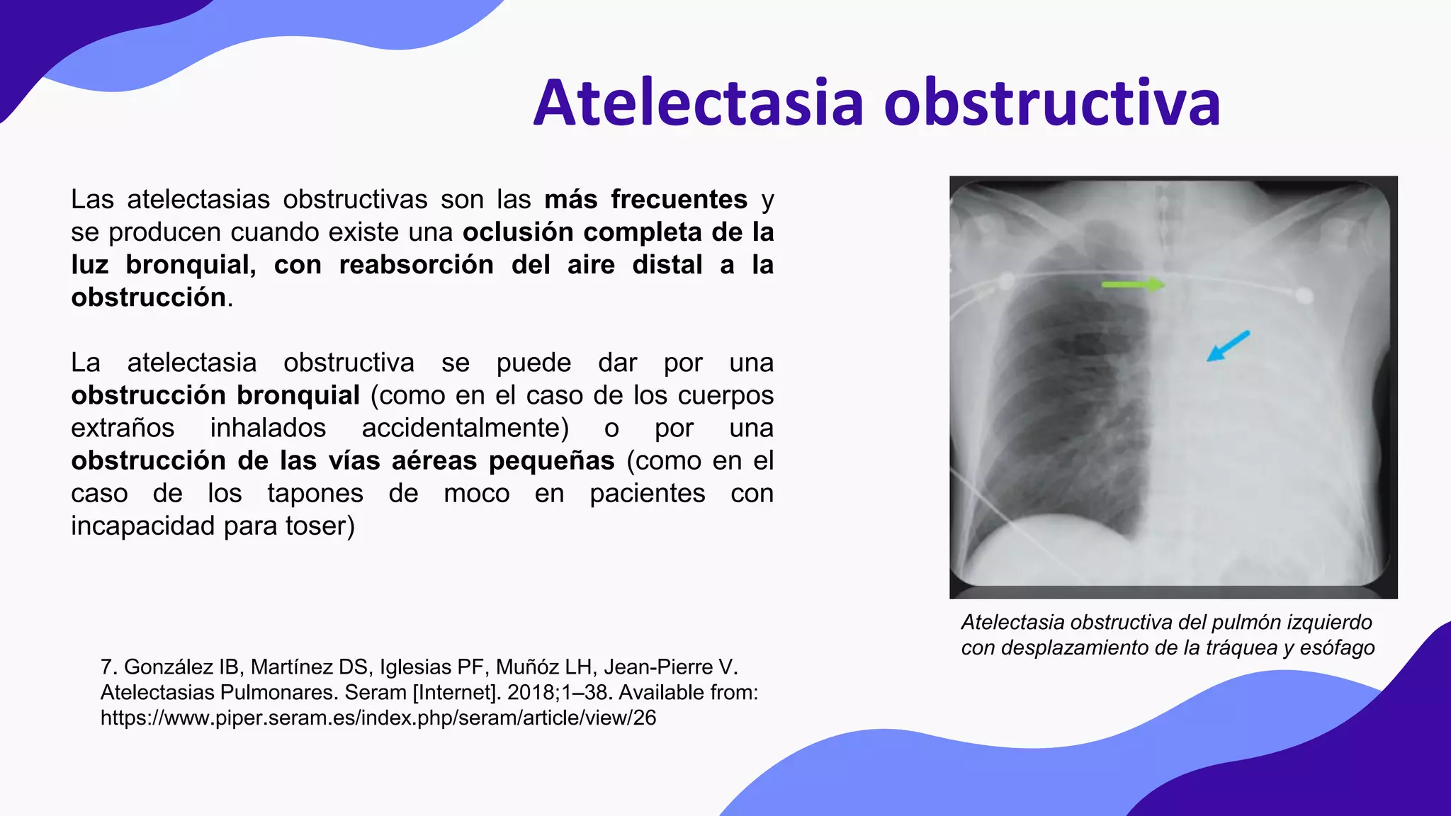 Atelectasia obstructiva
Las atelectasias obstructivas son las más frecuentes y
se producen cuando existe una oclusión completa de la
luz bronquial, con reabsorción del aire distal a la
obstrucción.
La atelectasia obstructiva se puede dar por una
obstrucción bronquial (como en el caso de los cuerpos
extraños inhalados accidentalmente) o por una
obstrucción de las vías aéreas pequeñas (como en el
caso de los tapones de moco en pacientes con
incapacidad para toser)
Atelectasia obstructiva del pulmón izquierdo
con desplazamiento de la tráquea y esófago
7. González IB, Martínez DS, Iglesias PF, Muñóz LH, Jean-Pierre V.
Atelectasias Pulmonares. Seram [Internet]. 2018;1–38. Available from:
https://www.piper.seram.es/index.php/seram/article/view/26
 