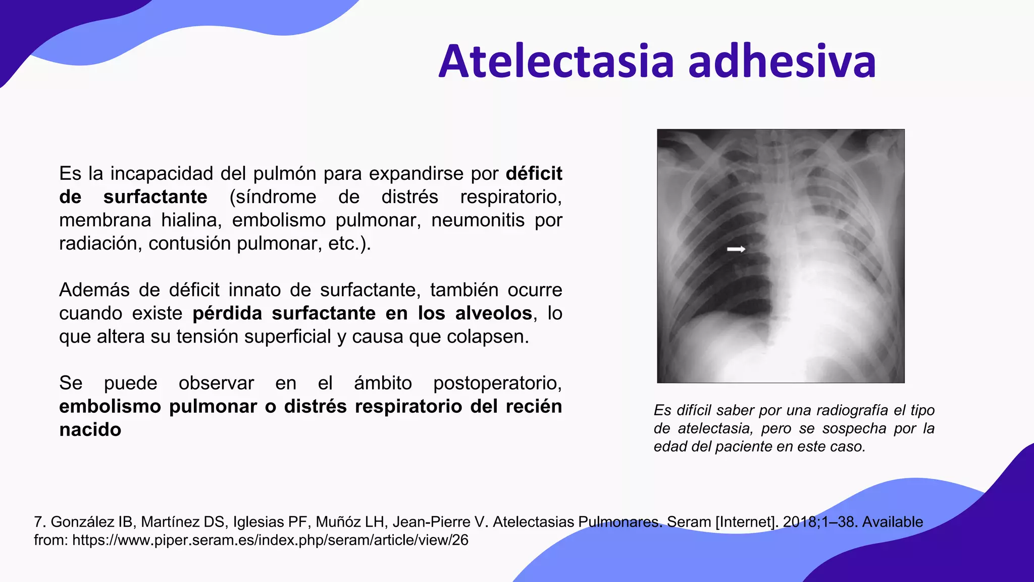 Atelectasia adhesiva
Es la incapacidad del pulmón para expandirse por déficit
de surfactante (síndrome de distrés respiratorio,
membrana hialina, embolismo pulmonar, neumonitis por
radiación, contusión pulmonar, etc.).
Además de déficit innato de surfactante, también ocurre
cuando existe pérdida surfactante en los alveolos, lo
que altera su tensión superficial y causa que colapsen.
Se puede observar en el ámbito postoperatorio,
embolismo pulmonar o distrés respiratorio del recién
nacido
7. González IB, Martínez DS, Iglesias PF, Muñóz LH, Jean-Pierre V. Atelectasias Pulmonares. Seram [Internet]. 2018;1–38. Available
from: https://www.piper.seram.es/index.php/seram/article/view/26
Es difícil saber por una radiografía el tipo
de atelectasia, pero se sospecha por la
edad del paciente en este caso.
 