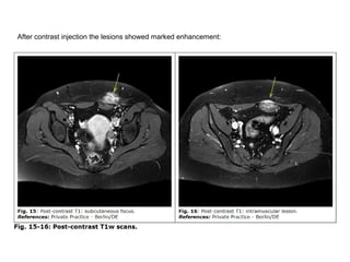 After contrast injection the lesions showed marked enhancement:
 