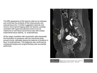The MRI appearance of the lesions ruled out an abscess
and confirmed the similarity of the intramuscular and
subcutaneous foci. It further suggested subacute and
chronic micro-hemorrhaging within the lesions, possibly
consistent with hypervascularized tumors such as
melanoma or soft tissue sarcoma but also with ectopic
endometrial tissue islands, i.e. endometriosis.

At this stage correlation with anamnestic data (especially
the fluctuation of symptoms with the menstrual cycle)
proved crucial, ultimately tipping the balance of evidence in
favor of endometriosis. This diagnosis was confirmed by
subsequent biopsy and surgical therapy was succesfully
performed.
 