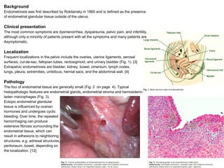 Background
Endometriosis was first described by Rokitansky in 1860 and is defined as the presence
of endometrial glandular tissue outside of the uterus.

Clinical presentation
The most common symptoms are dysmenorrhea, dyspareunia, pelvic pain, and infertility,
although only a minority of patients present with all the symptoms and many patients are
Asymptomatic.

Localization
Frequent localizations in the pelvis include the ovaries, uterine ligaments, serosal
surfaces, cul-de-sac, fallopian tubes, rectosigmoid, and urinary bladder (Fig. 1). [3]
Extrapelvic endometriosis are bladder, kidney, bowel, omentum, lymph nodes,
lungs, pleura, extremities, umbilicus, hernial sacs, and the abdominal wall. [4]

Pathology
The foci of endometrial tissue are generally small (Fig. 2 on page 4). Typical
histopathologic features are endometrial glands, endometrial stroma and hemosiderin-
laden macrophages (Fig. 3).
Ectopic endometrial glandular
tissue is influenced by ovarian
hormones and undergoes cyclic
bleeding. Over time, the repeated
hemorrhaging can produce
extensive fibrosis surrounding the
endometrial tissue, which can
result in adhesions to neighboring
structures, e.g. adnexal structures,
peritoneum, bowel, depending on
the localization. [12]
 
